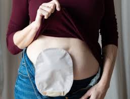Stoma Care 2