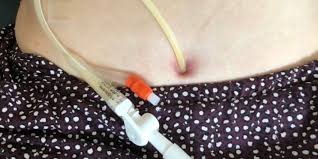 Urinary Catheter Care 2