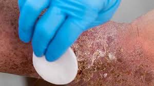 Wound Management -2