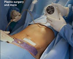 Wound Management -5